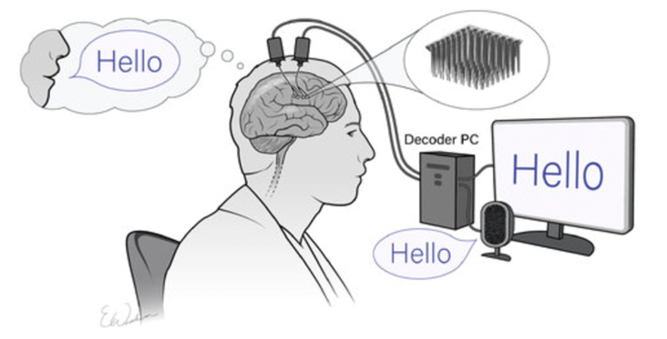 Diagram shows electrodes in a person's brain connected to a computer.