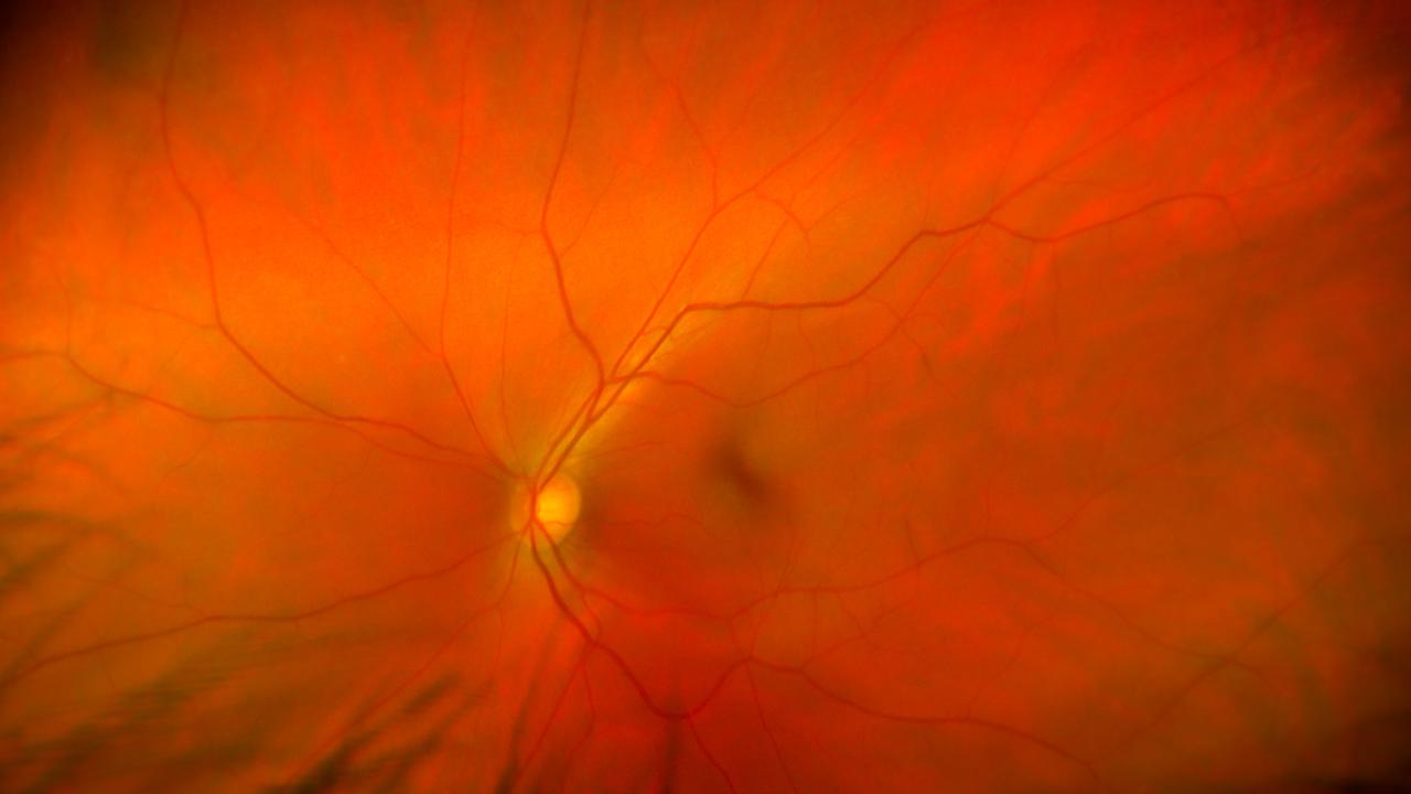 Orange-red background with a brighter yellow spot near center and irregular red blood vessels crossing the area 
