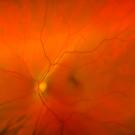 Orange-red background with a brighter yellow spot near center and irregular red blood vessels crossing the area 