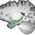 MRI image of brain with hippocampus in green