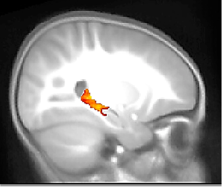 MRI scan